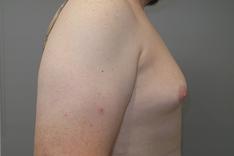Gynecomastia Before and After 23 | Grover Aesthetics