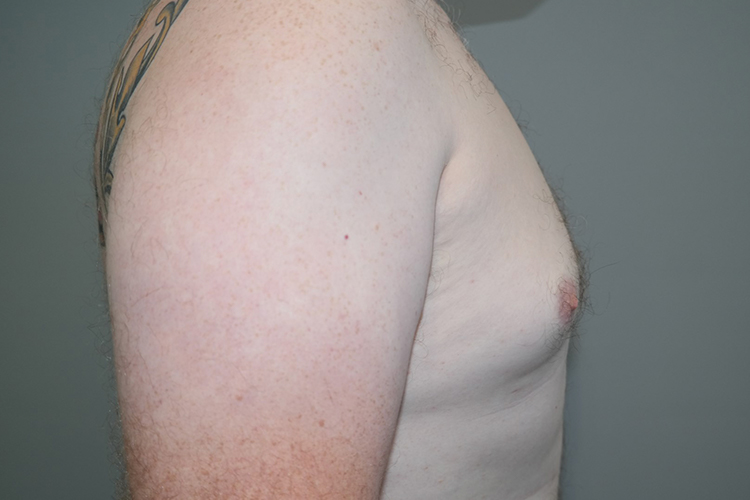 Gynecomastia Before and After 23 | Grover Aesthetics