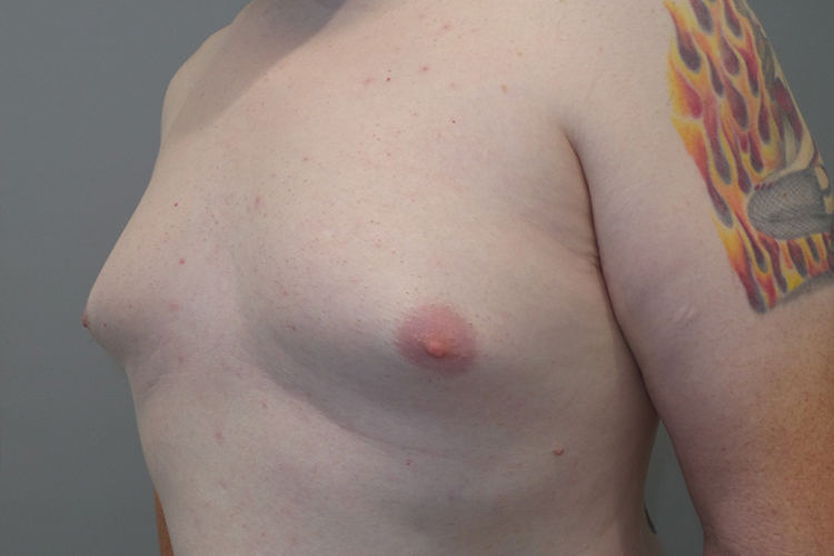 Gynecomastia Before and After 23 | Grover Aesthetics