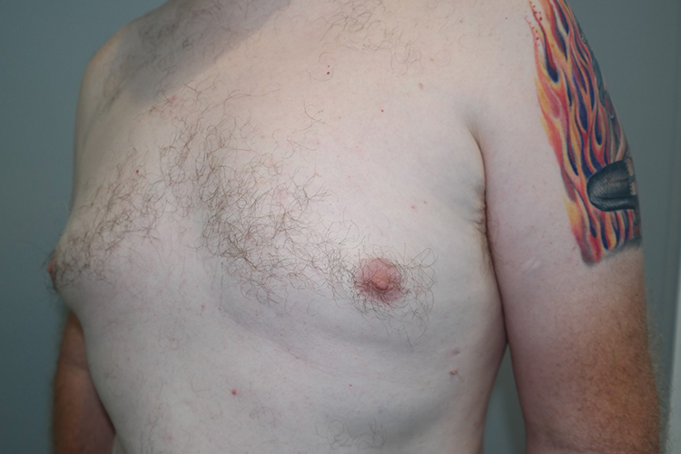 Gynecomastia Before and After 23 | Grover Aesthetics