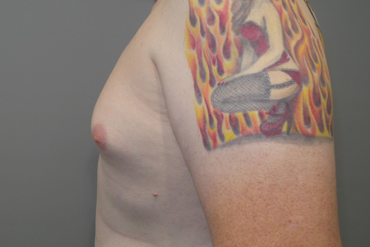 Gynecomastia Before and After 23 | Grover Aesthetics