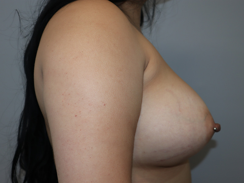 Hybrid Breast Augmentation Before and After 01 | Sanjay Grover MD FACS