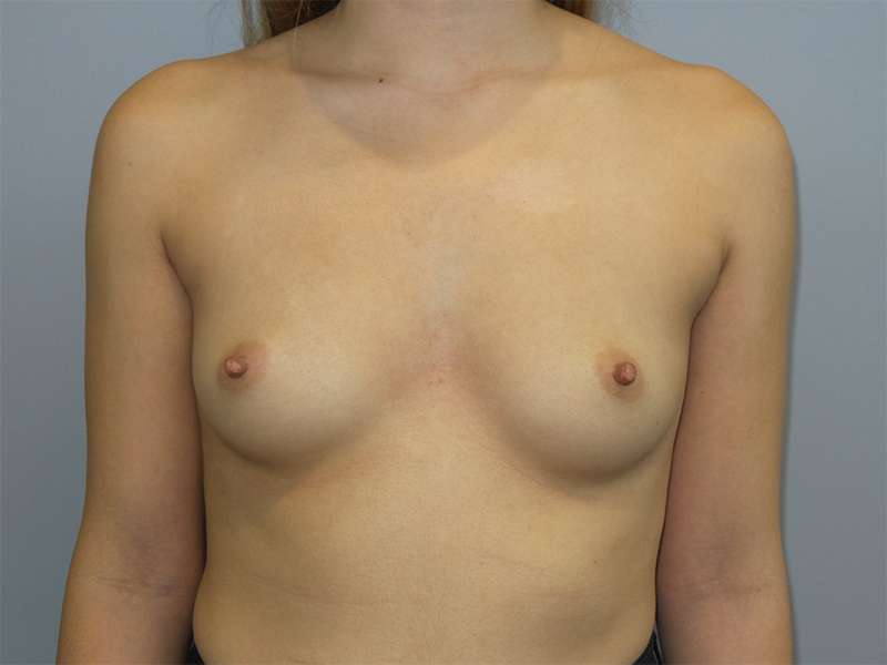 Hybrid Breast Augmentation Before and After | Grover Aesthetics