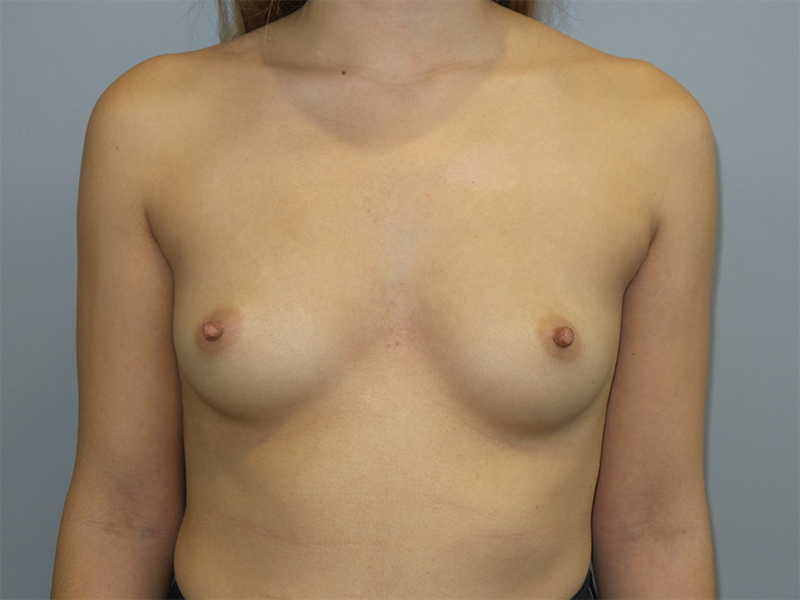 Hybrid Breast Augmentation Before and After 07 | Sanjay Grover MD FACS