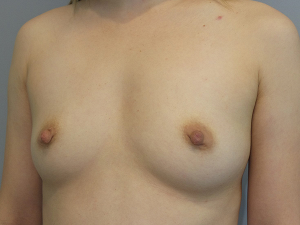 Hybrid Breast Augmentation Before and After 05 | Sanjay Grover MD FACS