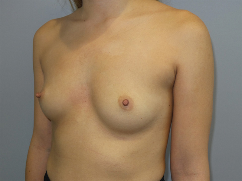 Hybrid Breast Augmentation Before and After 05 | Sanjay Grover MD FACS