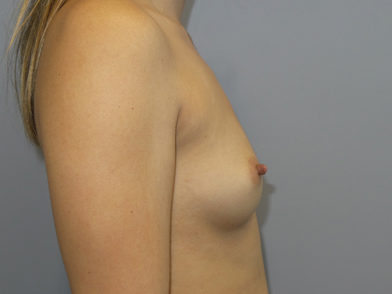 Hybrid Breast Augmentation Before and After 05 | Sanjay Grover MD FACS