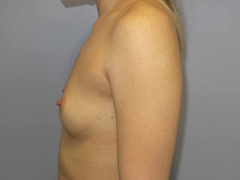 Hybrid Breast Augmentation Before and After 05 | Sanjay Grover MD FACS