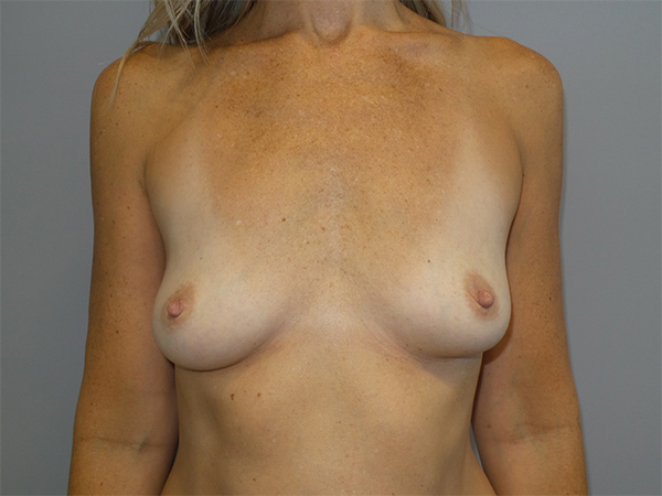 Hybrid Breast Augmentation Before and After 01 | Sanjay Grover MD FACS