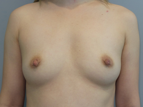 Hybrid Breast Augmentation Before and After 05 | Sanjay Grover MD FACS