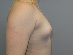 Hybrid Breast Augmentation Before and After 07 | Sanjay Grover MD FACS