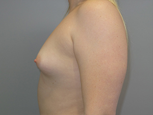 Hybrid Breast Augmentation Before and After 07 | Sanjay Grover MD FACS