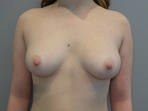 Hybrid Breast Augmentation Before and After 09 | Sanjay Grover MD FACS