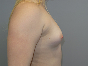 Hybrid Breast Augmentation Before and After 08 | Sanjay Grover MD FACS