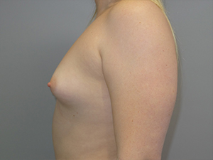 Hybrid Breast Augmentation Before and After 08 | Sanjay Grover MD FACS