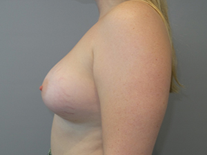 Hybrid Breast Augmentation Before and After 08 | Sanjay Grover MD FACS