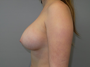 Hybrid Breast Augmentation Before and After 09 | Sanjay Grover MD FACS