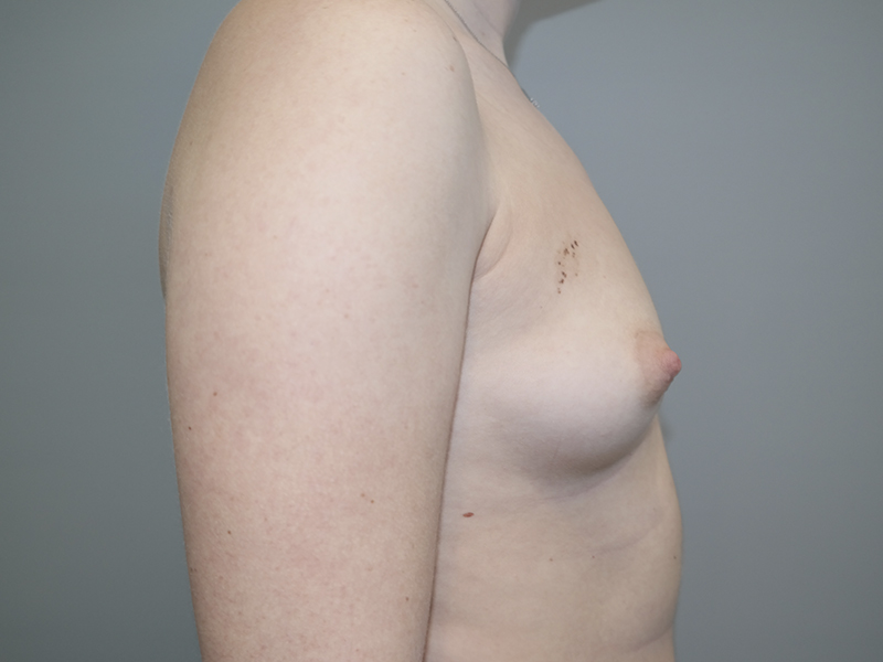 Hybrid Breast Augmentation Before and After 10 | Sanjay Grover MD FACS