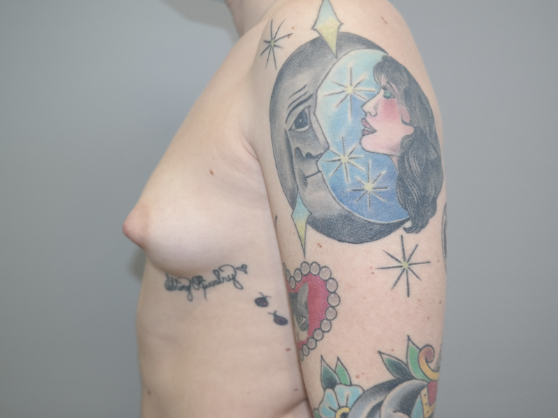 Hybrid Breast Augmentation Before and After 11 | Grover Aesthetics