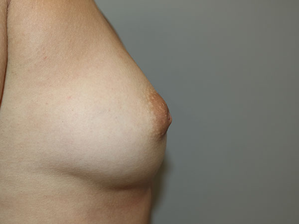 Inverted Nipple Repair Before and After 01 | Grover Aesthetics