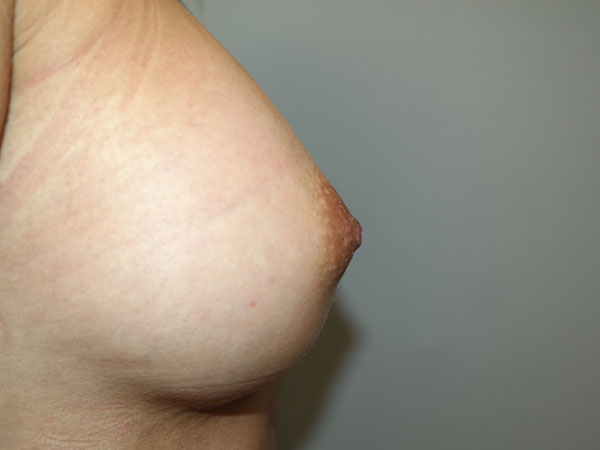 Inverted Nipple Repair Before and After 01 | Grover Aesthetics