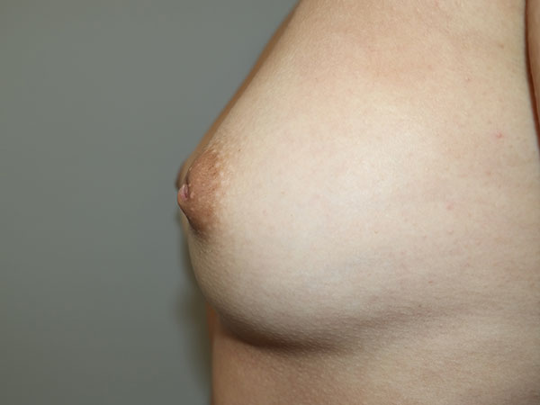 Inverted Nipple Repair Before and After 01 | Grover Aesthetics