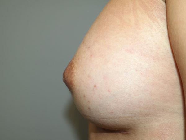 Inverted Nipple Repair Before and After 01 | Grover Aesthetics
