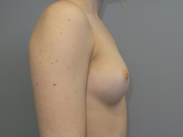 Inverted Nipple Repair Before and After 02 | Grover Aesthetics