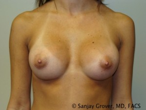 Mini Breast Augmentation Before and After 01 | Sanjay Grover MD FACS