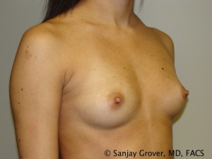 Mini Breast Augmentation Before and After 01 | Sanjay Grover MD FACS