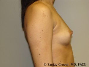 Mini Breast Augmentation Before and After 01 | Sanjay Grover MD FACS