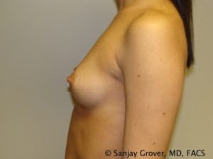 Mini Breast Augmentation Before and After 01 | Grover Aesthetics