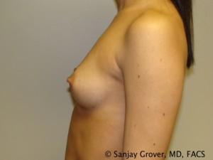 Mini Breast Augmentation Before and After 01 | Sanjay Grover MD FACS