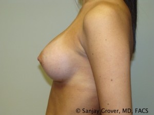 Mini Breast Augmentation Before and After 01 | Sanjay Grover MD FACS