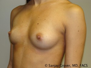 Mini Breast Augmentation Before and After 01 | Sanjay Grover MD FACS