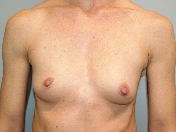 Mini Breast Augmentation Before and After 09 | Sanjay Grover MD FACS