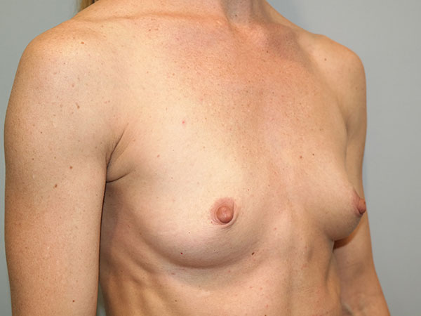Mini Breast Augmentation Before and After 02 | Grover Aesthetics
