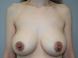 Mini Breast Augmentation Before and After | Grover Aesthetics