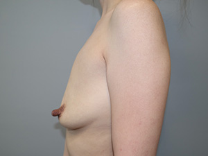 Mini Breast Augmentation Before and After 04 | Grover Aesthetics