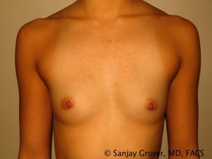 Mini Breast Augmentation Before and After 01 | Sanjay Grover MD FACS