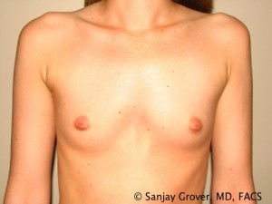 Mini Breast Augmentation Before and After | Grover Aesthetics