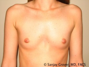 Mini Breast Augmentation Before and After 04 | Sanjay Grover MD FACS