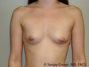 Mini Breast Augmentation Before and After 05 | Sanjay Grover MD FACS