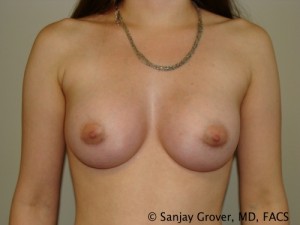 Mini Breast Augmentation Before and After | Grover Aesthetics