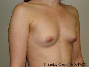 Mini Breast Augmentation Before and After 07 | Grover Aesthetics
