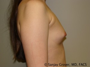 Mini Breast Augmentation Before and After 07 | Sanjay Grover MD FACS