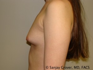 Mini Breast Augmentation Before and After 07 | Grover Aesthetics