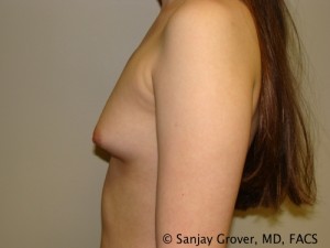 Mini Breast Augmentation Before and After 07 | Sanjay Grover MD FACS