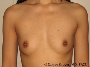 Mini Breast Augmentation Before and After | Grover Aesthetics