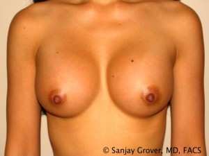 Mini Breast Augmentation Before and After | Grover Aesthetics